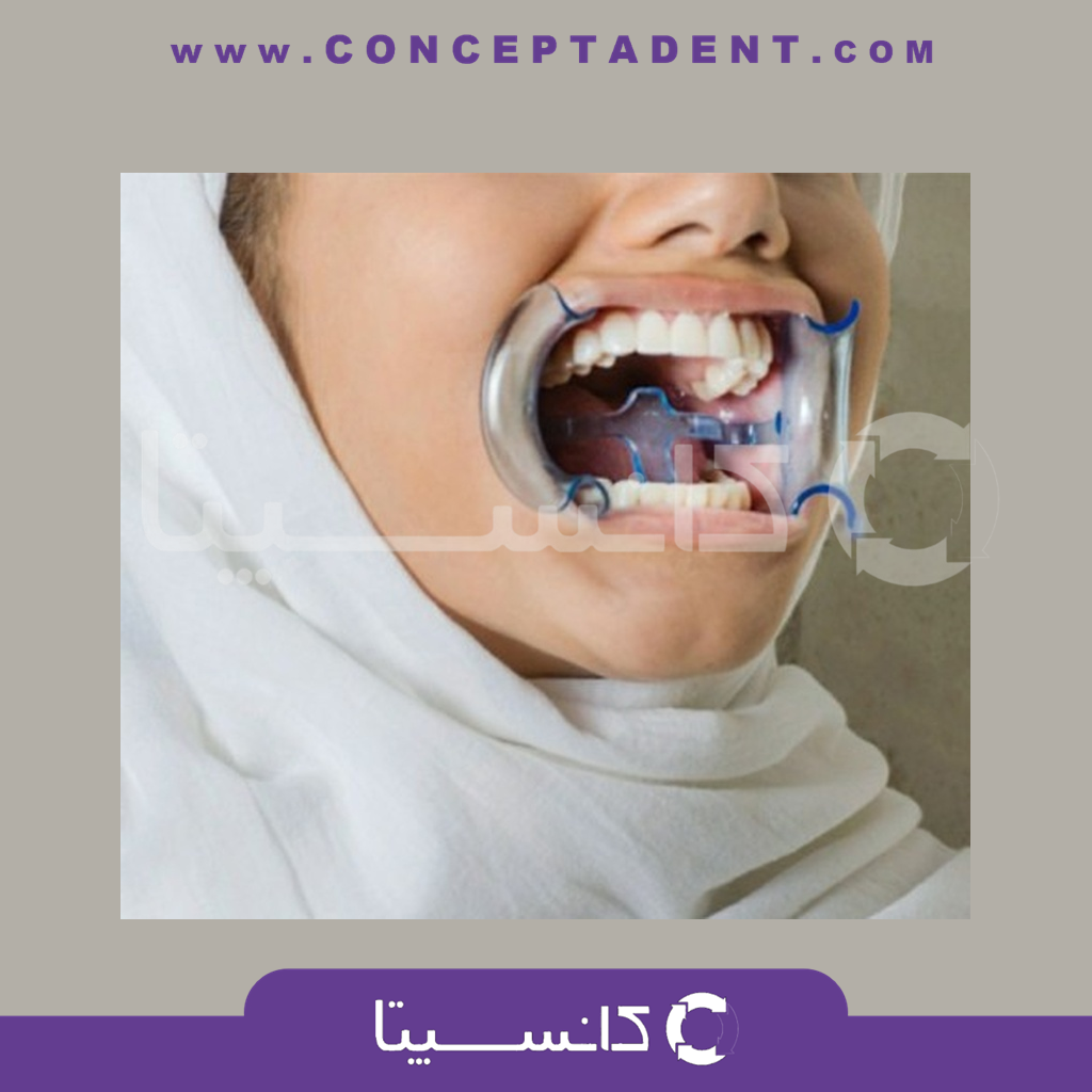 دهان بازکن داخل دهانی قابل اتوکلاو – Autoclavable Intraoral Mouth Opener