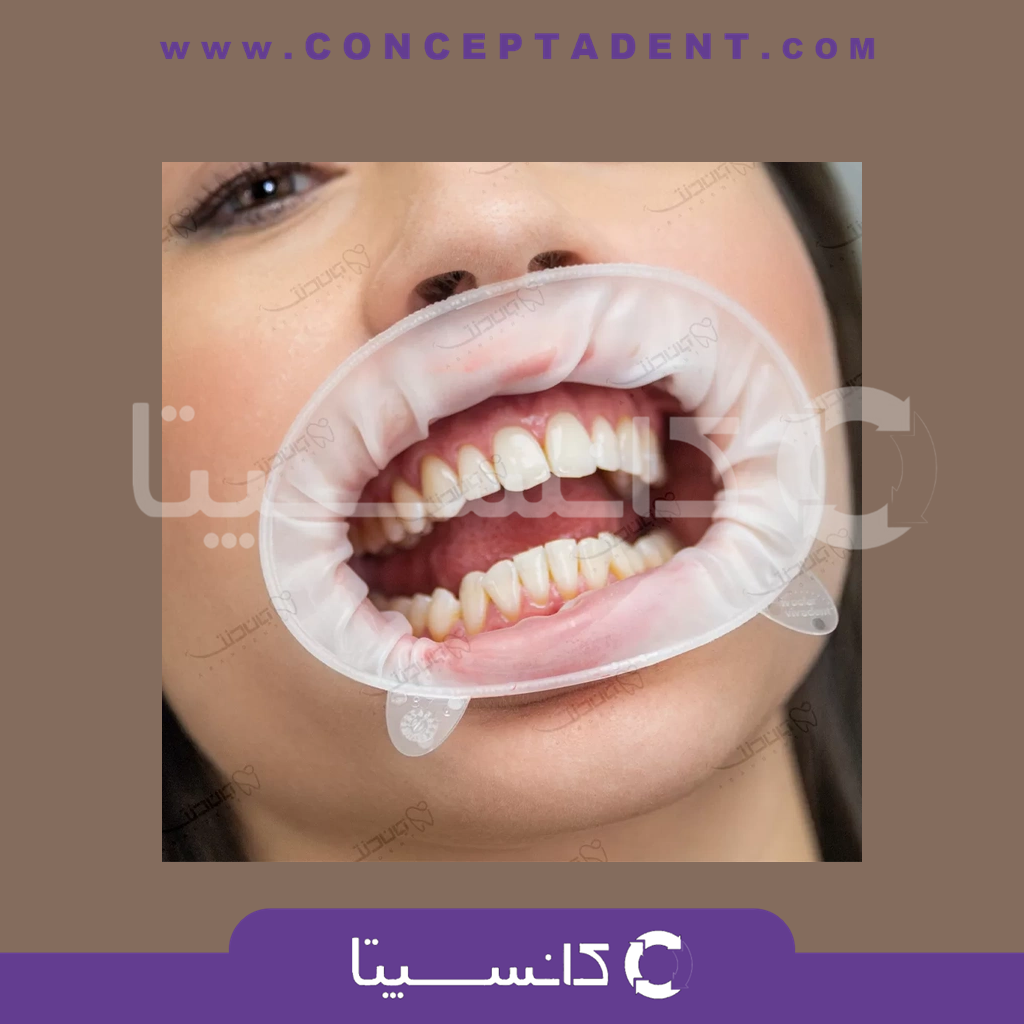 دهان باز کن اپتراگیت ایوکلار – IVOCLAR optragate