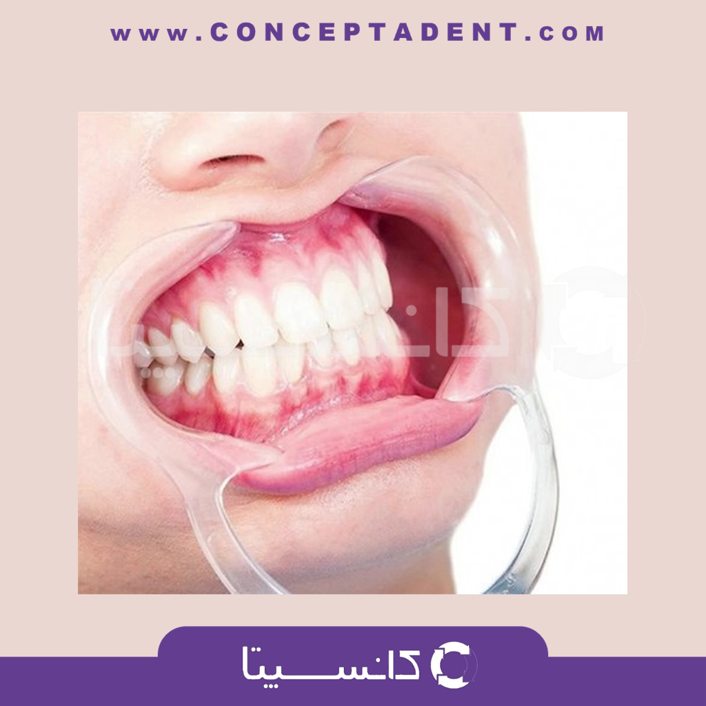 دهان بازکن دو طرفه نعلی شکل مات – Cotisen