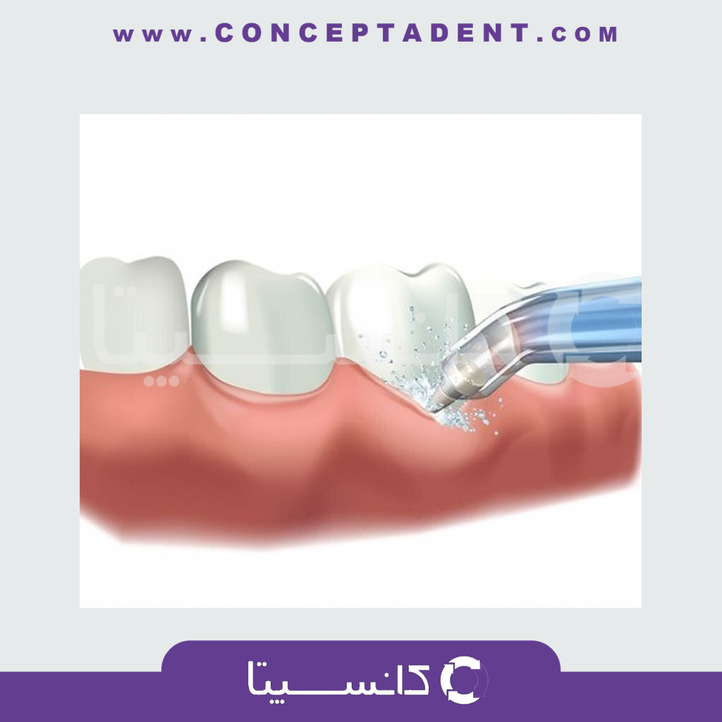 نازل سوزنی پریودنتال پاکت مدل Waterpulse – DE-300