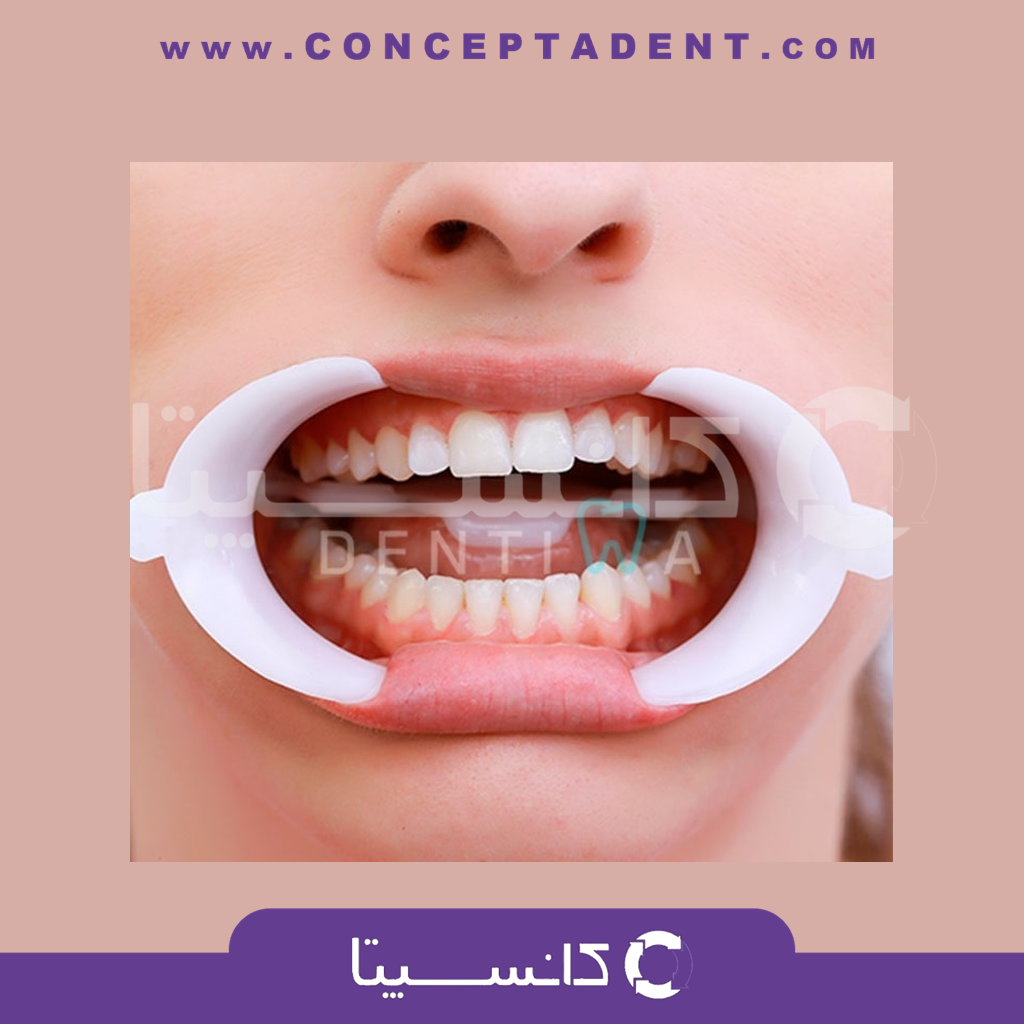 دهان بازکن – Arc flex