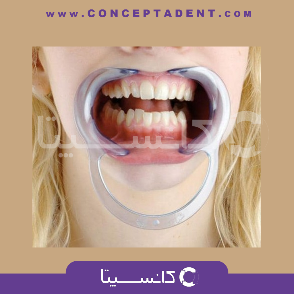 دهان بازکن دو طرفه نعلی شکل (طرح آلمانی) – سامان زر دندان