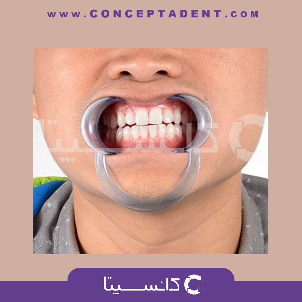 دهان بازکن دو طرفه نعلی شکل (طرح آلمانی) – سامان زر دندان