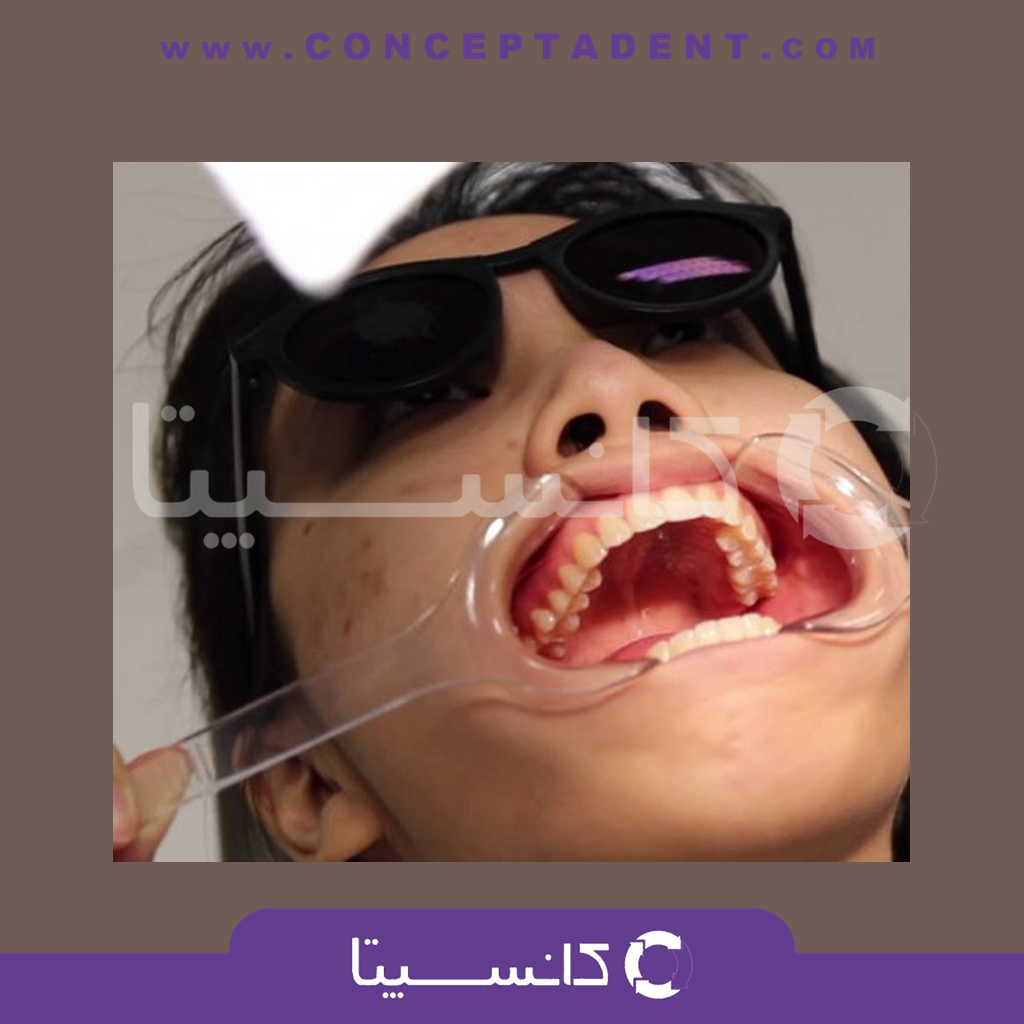 دهان بازکن یکطرفه شفاف – Cotisen