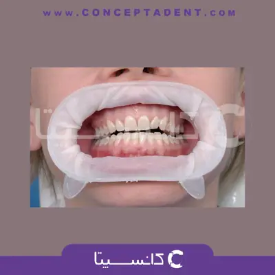 دهان بازکن اپتراگیت – OptraGate