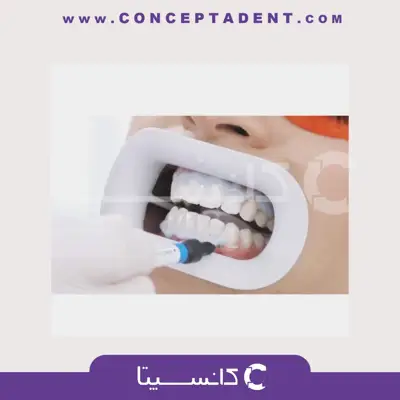 دهان‌ بازکن فلش‌ لیپ وایت اسمایل – Flash Lip Retractor