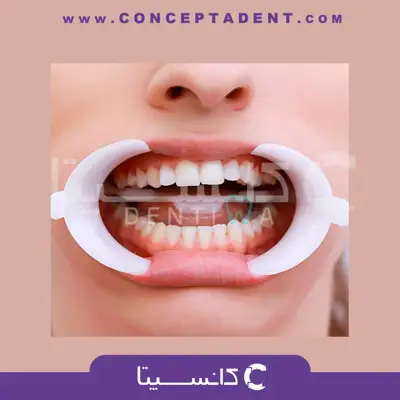 دهان بازکن – Arc flex