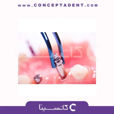 لوگزاتور روت پیکر – Root Picker Luxator