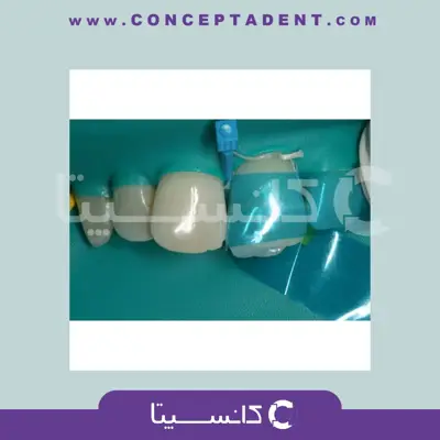 ماتریکس بند پلاستیکی قدامی – Matrix Sectional