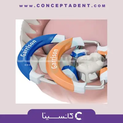 رینگ سکشنال گریسون – Fussion Tight Premolar